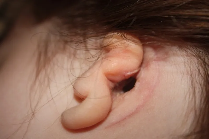 atresia-repair-surgery Atresia Repair Surgery