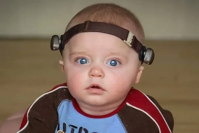 atresia-treatment-2 Baby with bone conduction hearing device