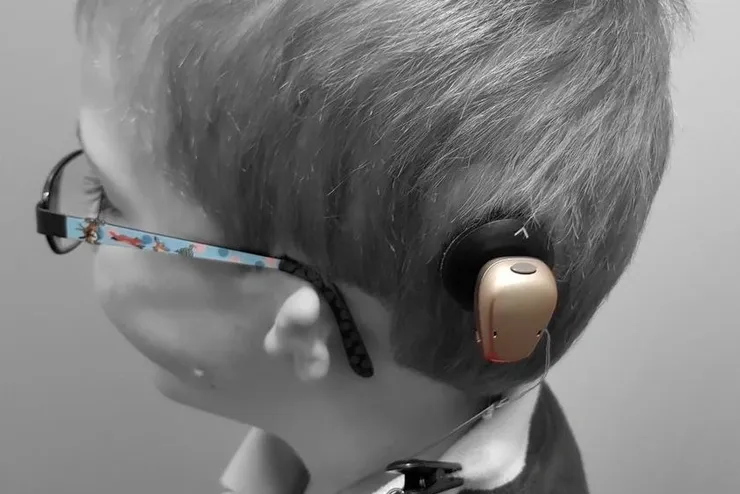 atresia-treatment-3 Child with bone conduction hearing device