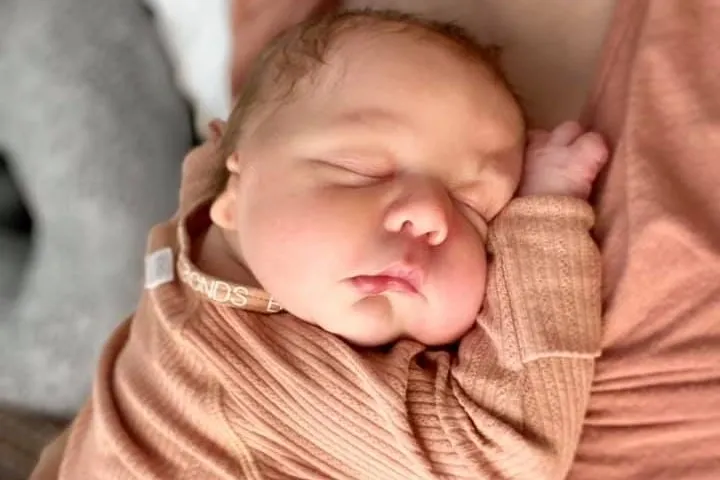 Sleeping baby with microtia