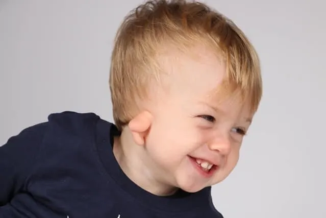 mictoria-treatment-photos Toddler boy with microtia