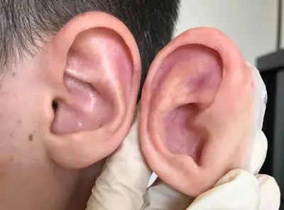 prosthetic-ear Prosthetic Ear