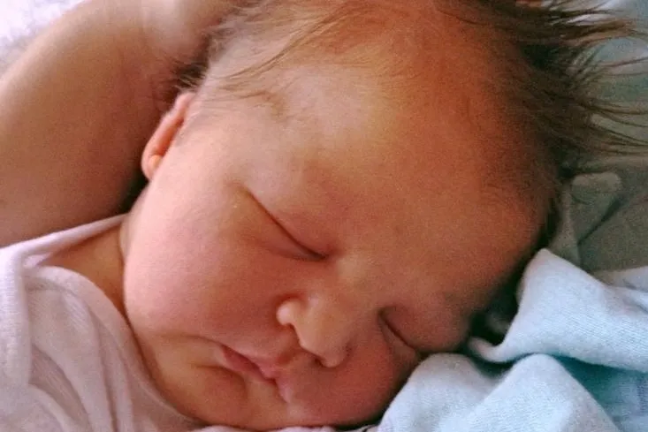 Sleeping baby with microtia
