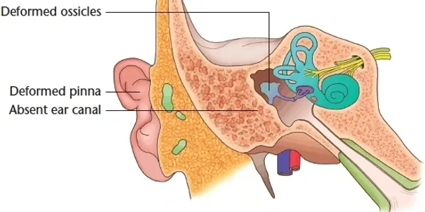 deformed-ear-anatomy Diagram of cross-section of deformed ear anatomy